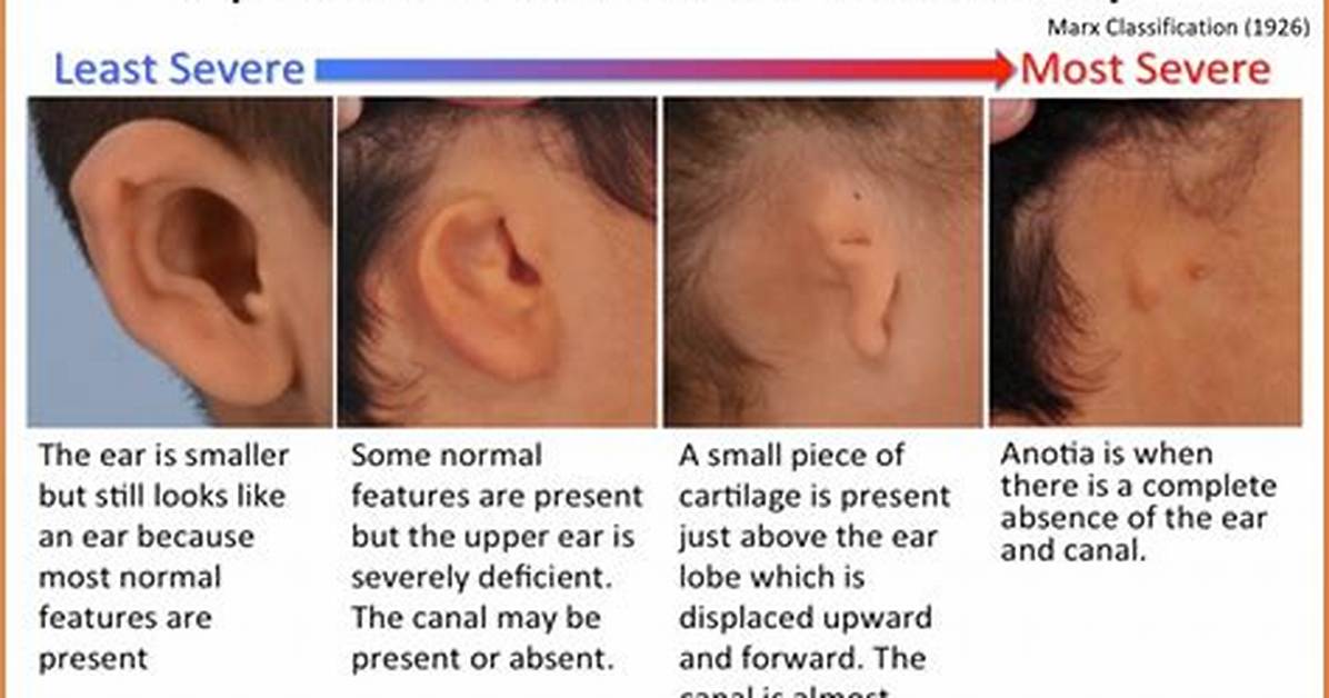 What Does Microtia Atresia Mean?
