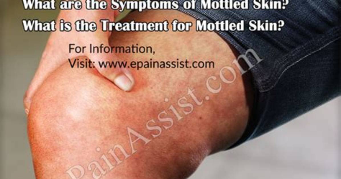 What Does Mottled Mean?