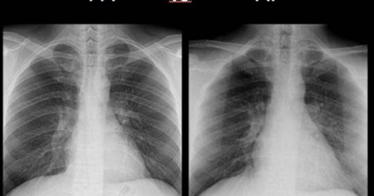 What Does Pa Stand for Xray