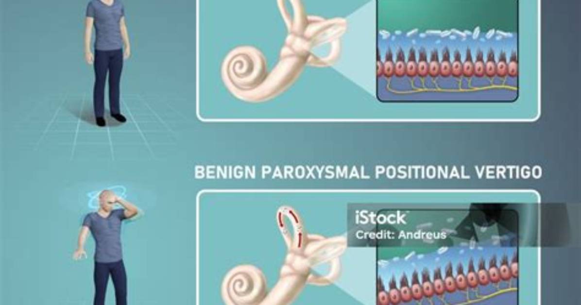 What Does Paroxysmal Mean?