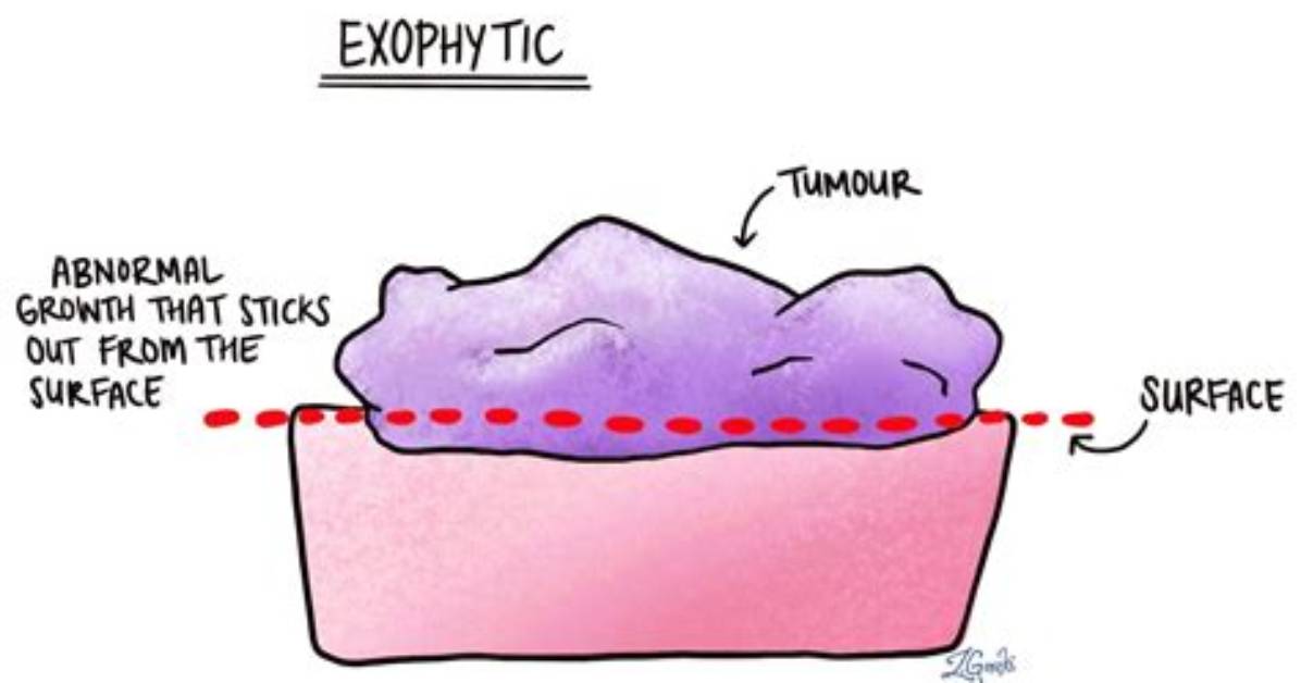 What Does Partially Exophytic Mean?