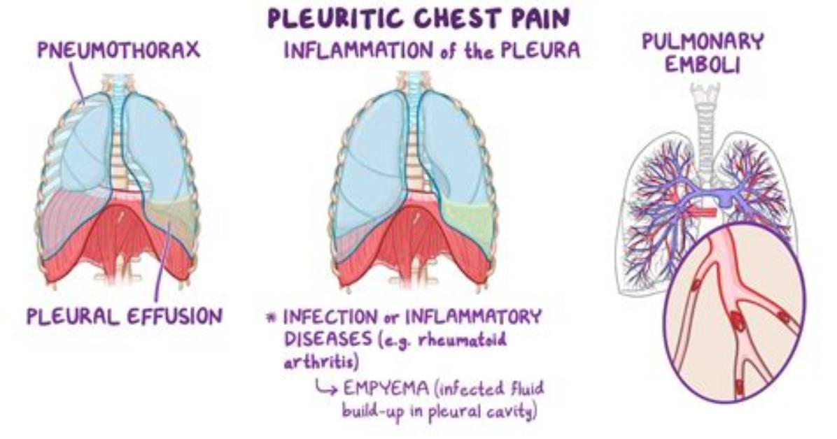 What Does Pleuropulmonary Mean?