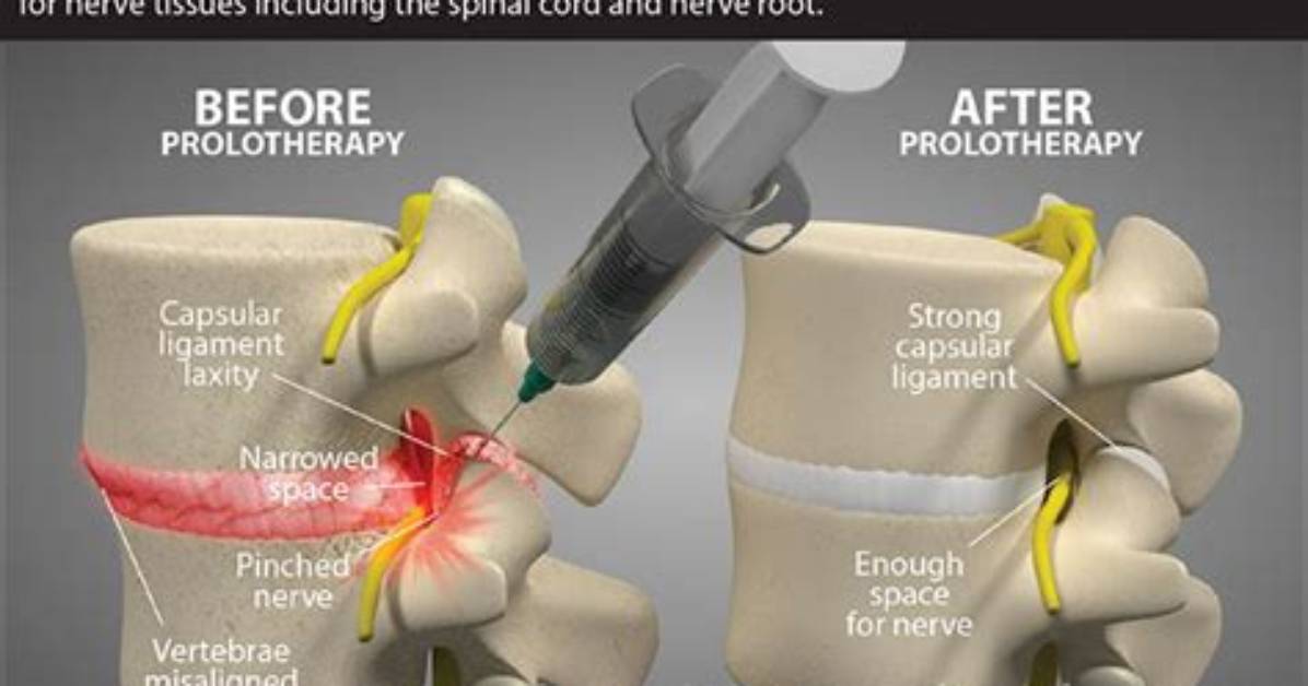What Does Prolotherapy Mean?