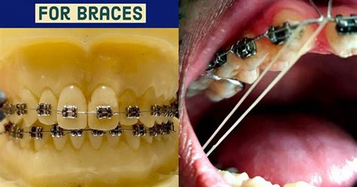 What Does Rubber Bands for Braces Do