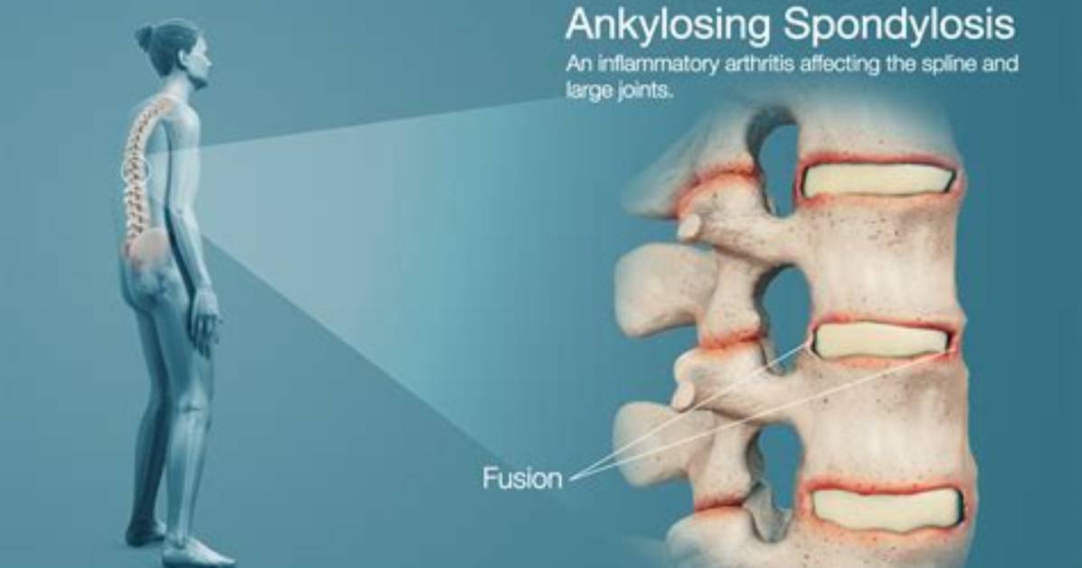 What Does Spondyl O Mean