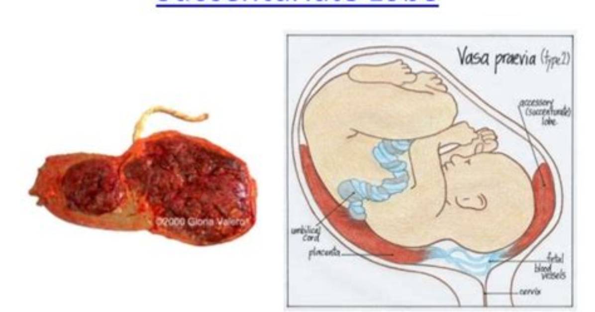 What Does Succenturiate Lobe Mean?