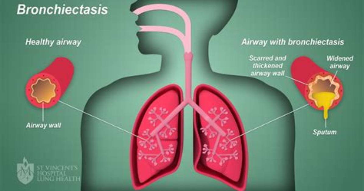 What Does the Term Bronchorrhea Mean?