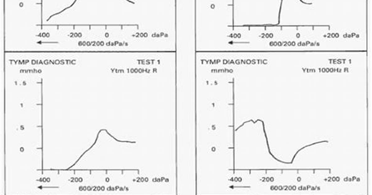 What Does Type as Tympanogram Mean