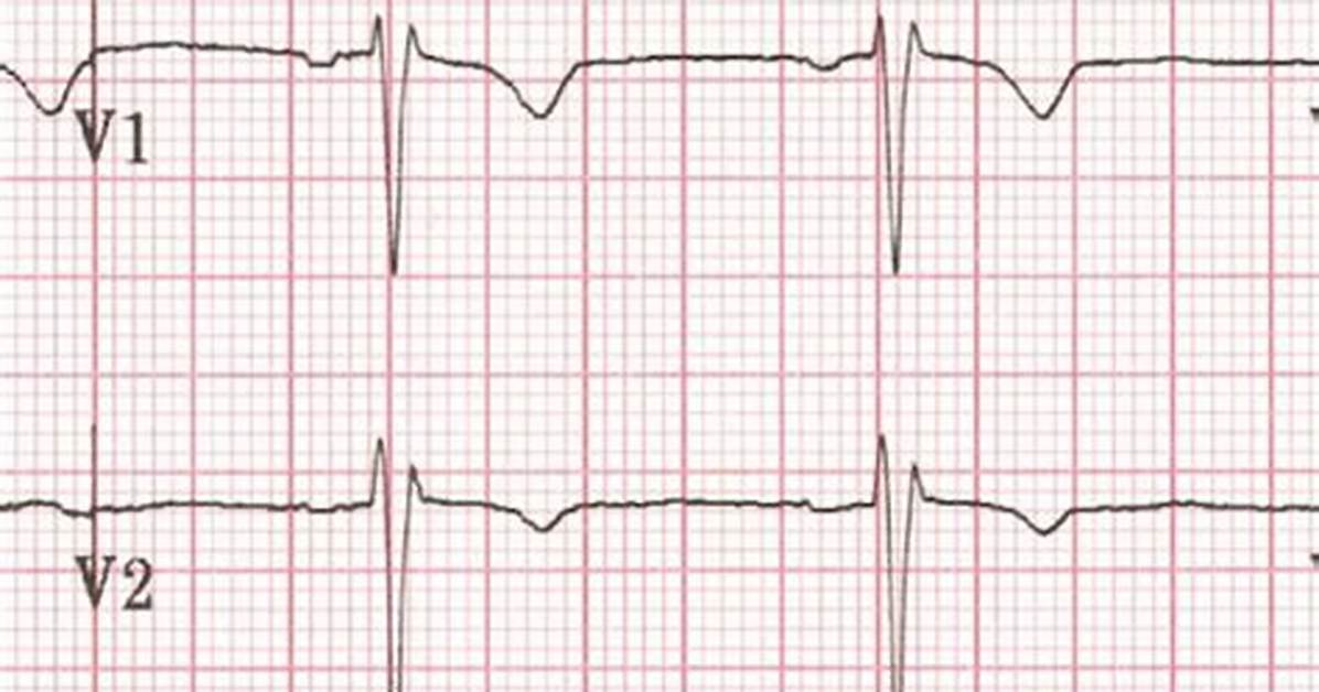 What Does V1 Mean on Ecg