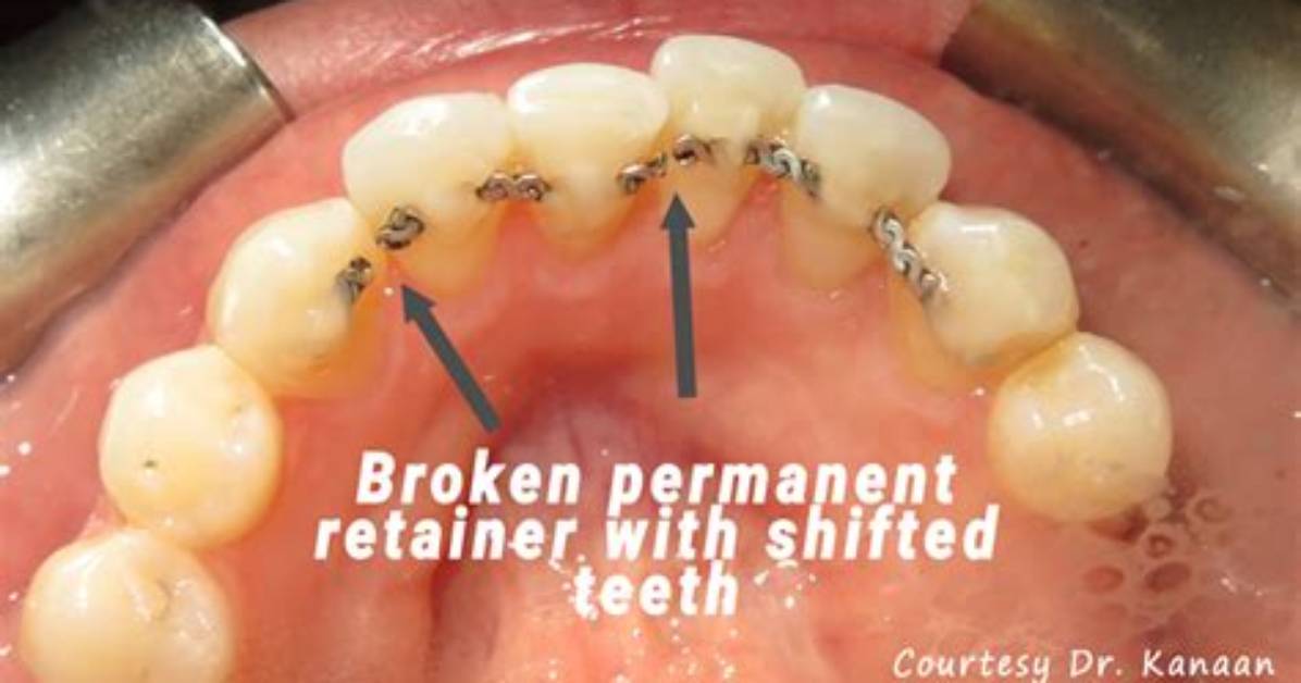 What Happens If Permanent Retainer Comes off?