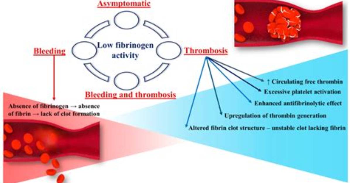 What Happens When Fibrinogen Is Low?