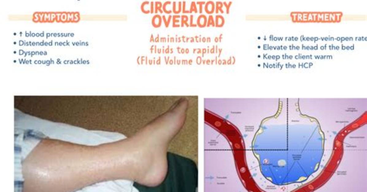 What Helps Fluid Overload