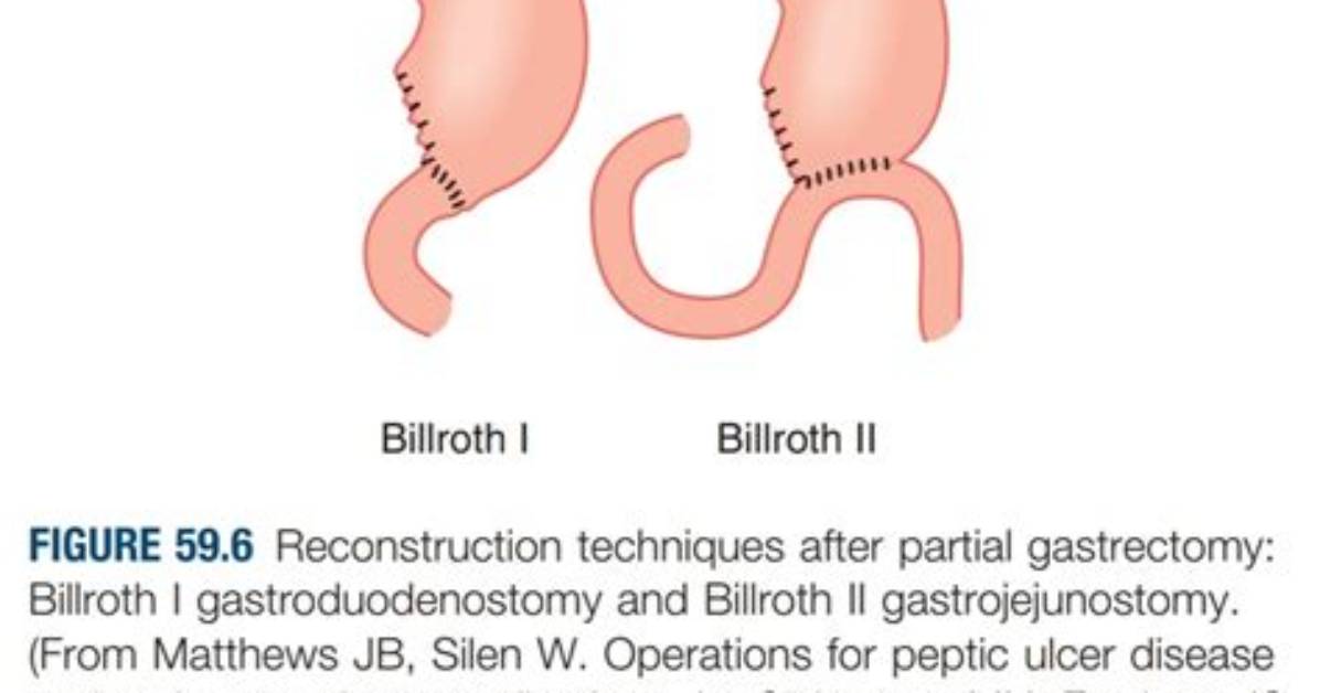 What Is a Billroth Procedure?
