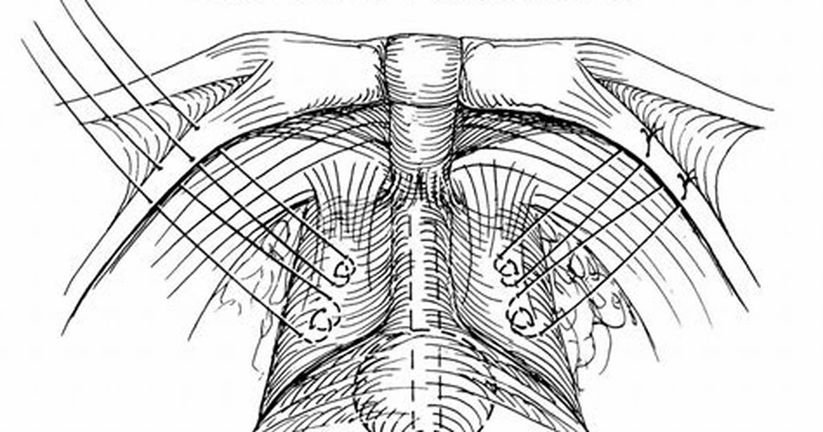 What Is a Burch Procedure?
