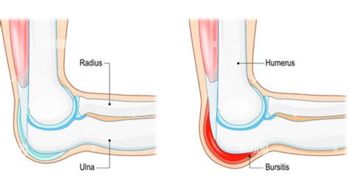 What Is a Bursa on a Bone