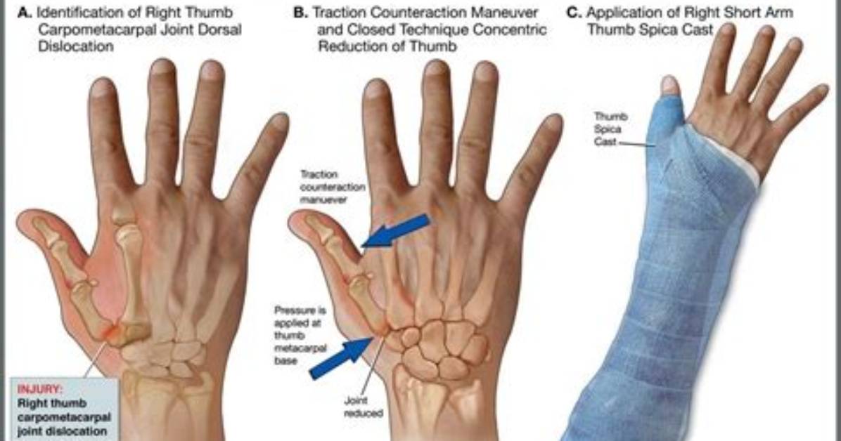 What Is a Closed Reduction of the Wrist