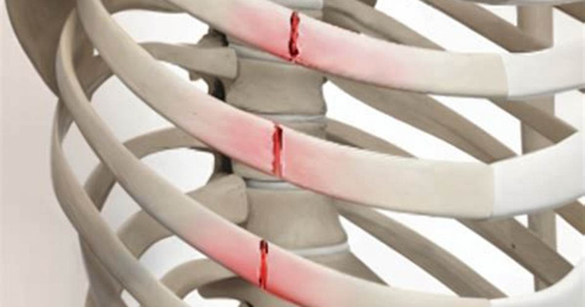 What Is a Compressed Rib