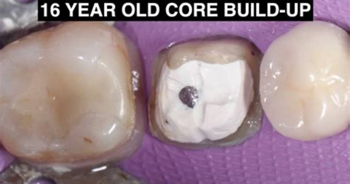What Is a Core Build Up