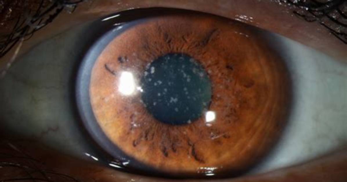 What Is a Corneal Dystrophy