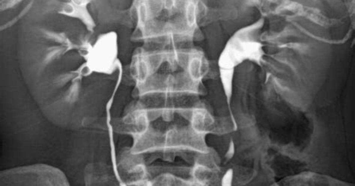 What Is a Ct Intravenous Pyelogram?