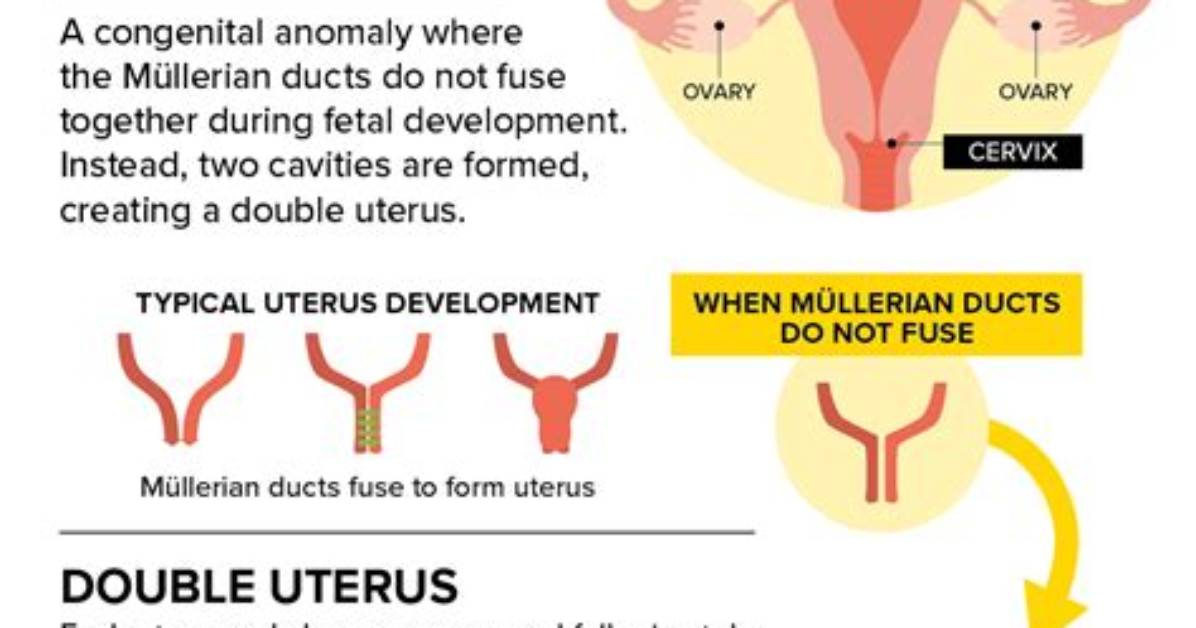 What Is a Double Womb?
