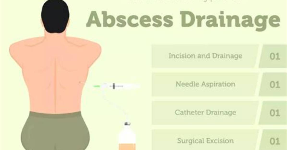 What Is a Draining Abscess?