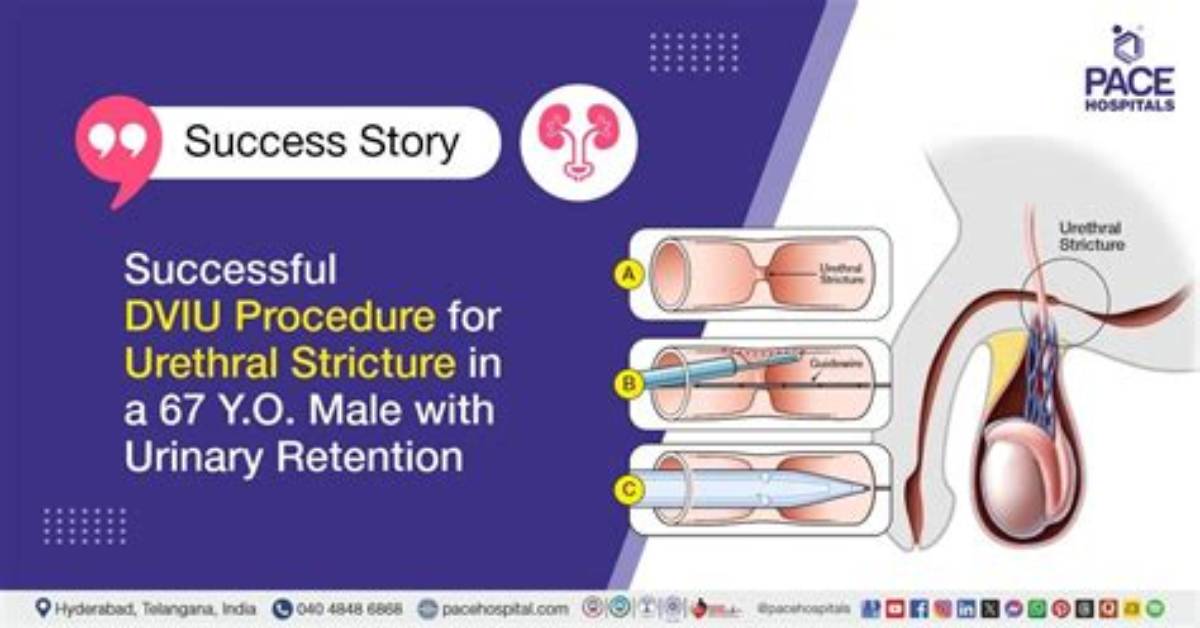 What Is a Dviu Procedure?
