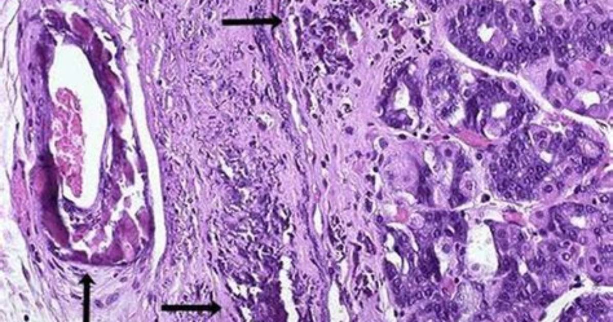 What Is a Dystrophic Calcification