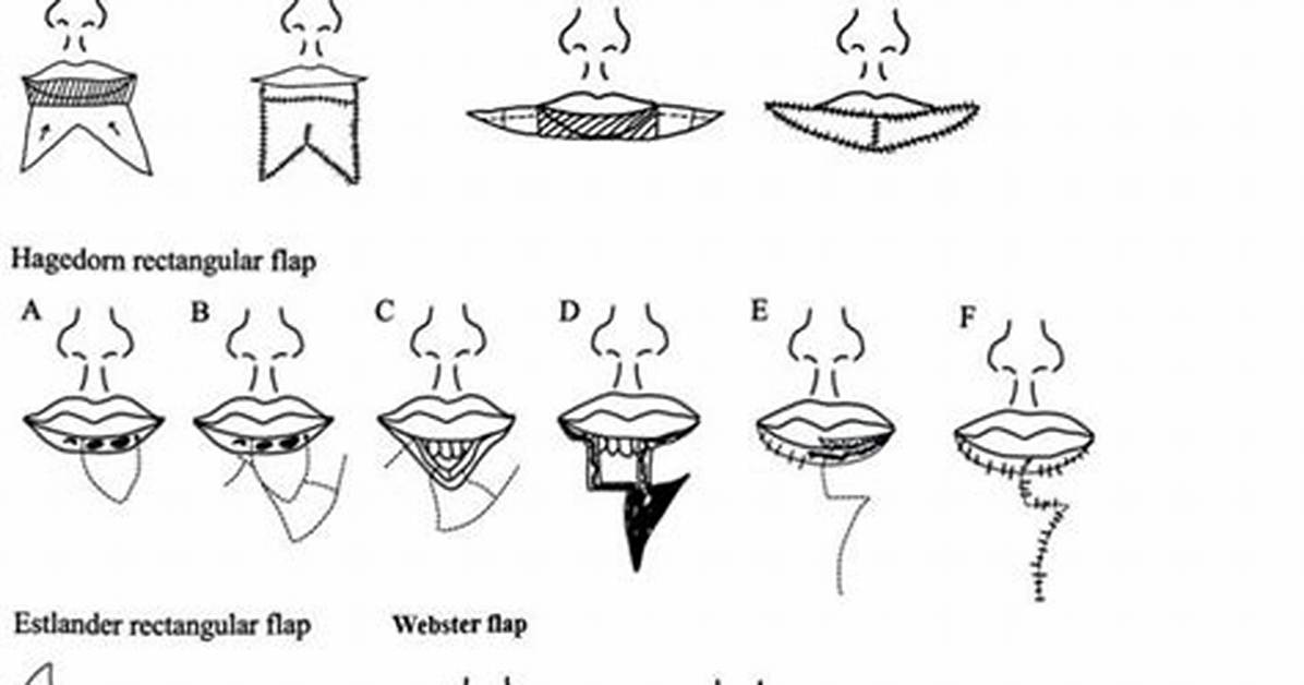 What Is a Flap?