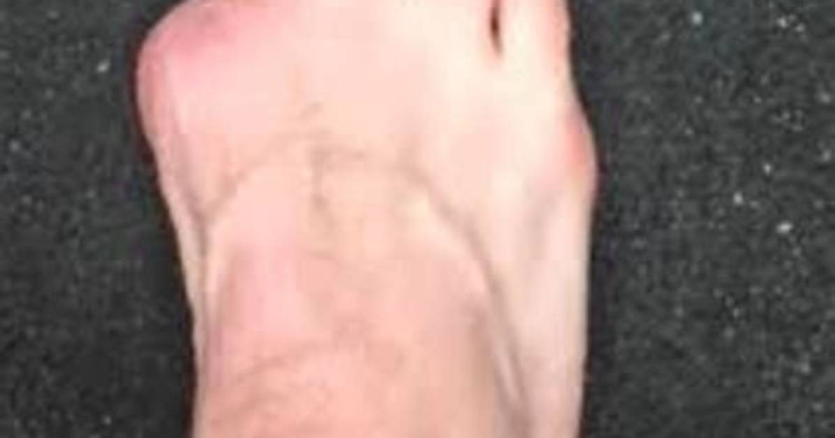 What Is a Hallux Amputation
