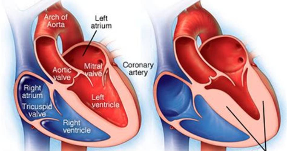What Is a Hyperdynamic Heart?