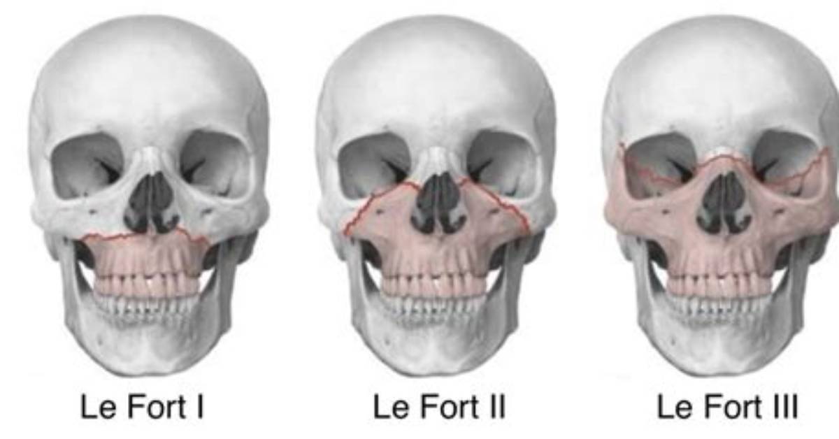 What Is a Lefort Procedure?