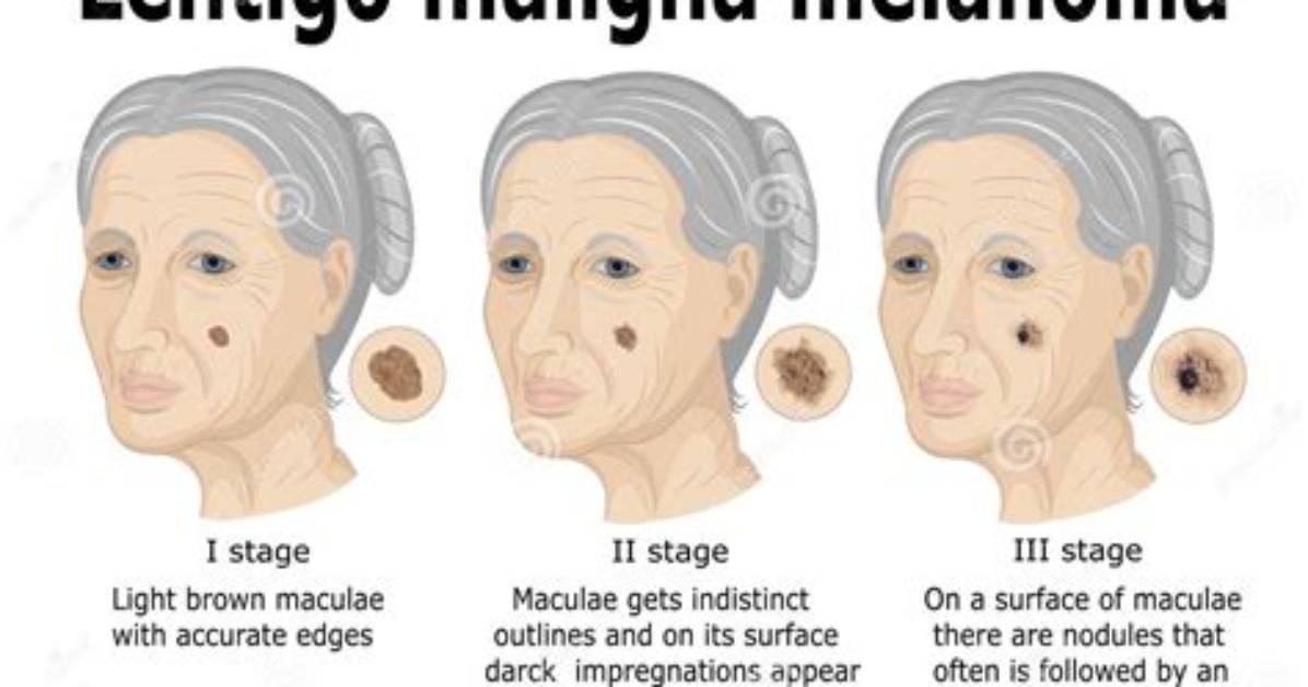 What Is a Lentigo Maligna