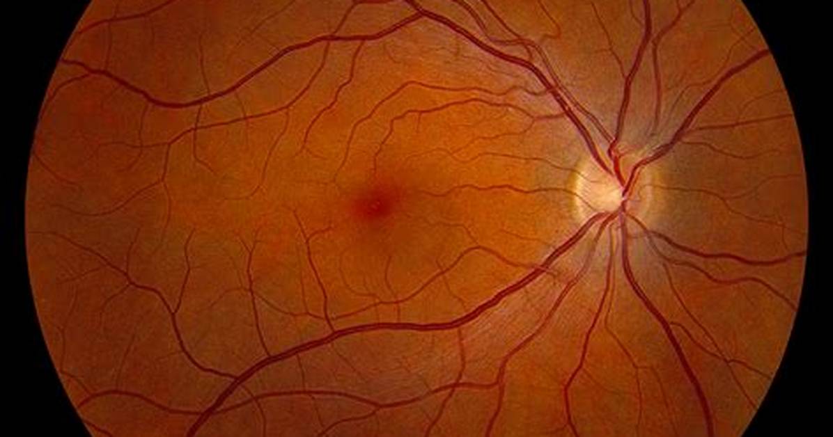 What Is a Normal Fundus?