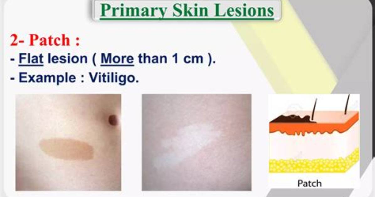 What Is a Patch Lesion