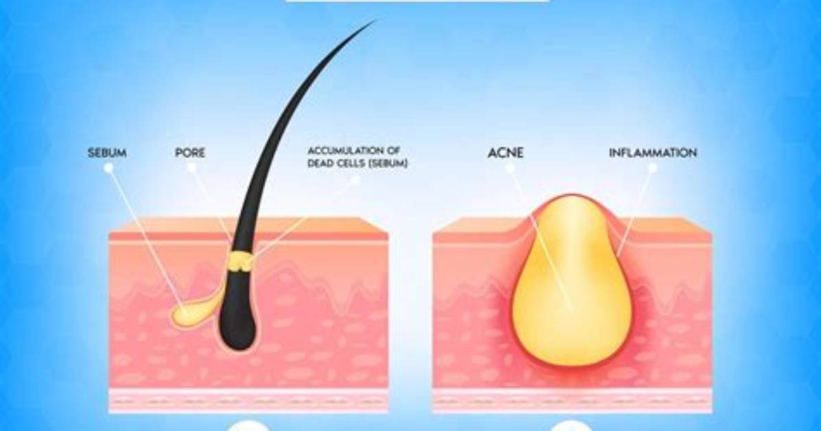 What Is a Pimple Core?