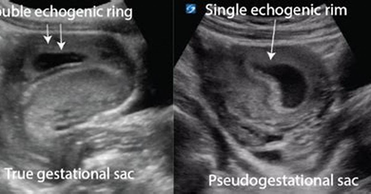 What Is a Pseudosac