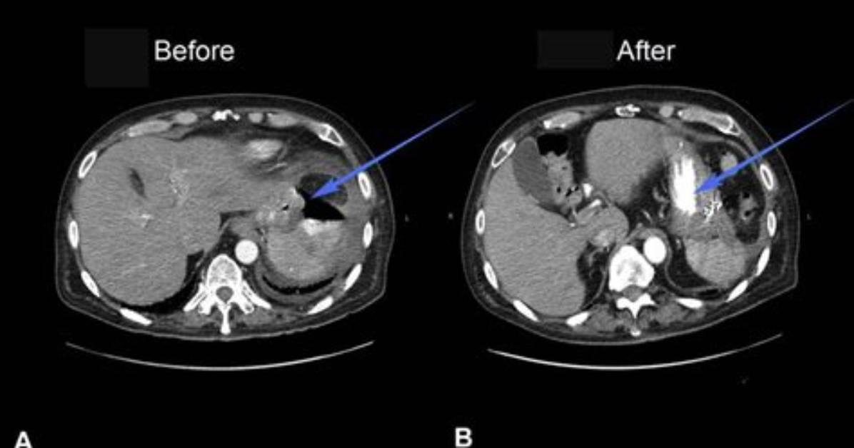 What Is a Retroperitoneal Abscess