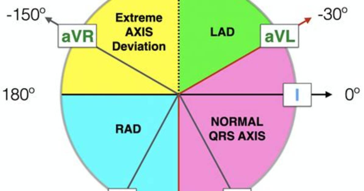 What Is a Right Axis Deviation in the Heart