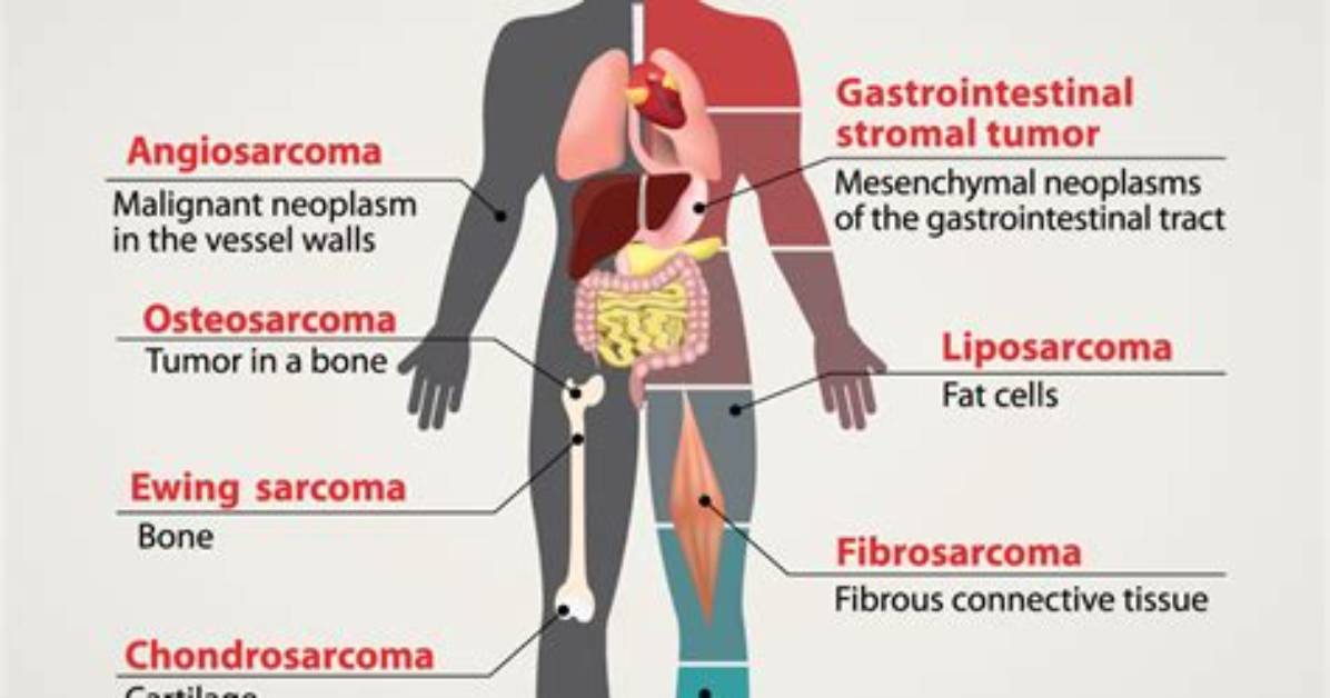 What Is a Sarcoma Lump?