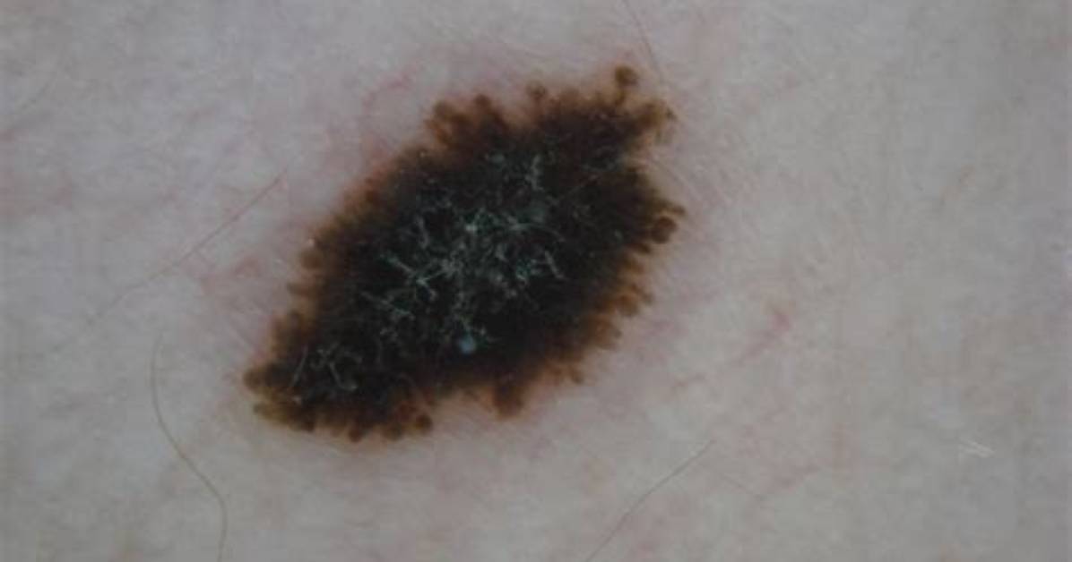 What Is a Spitz Nevus?