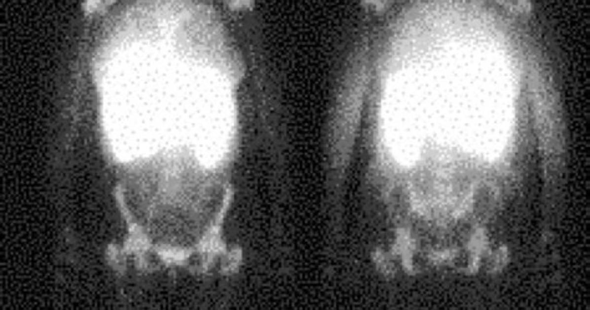 What Is a Sulfur Colloid Scan