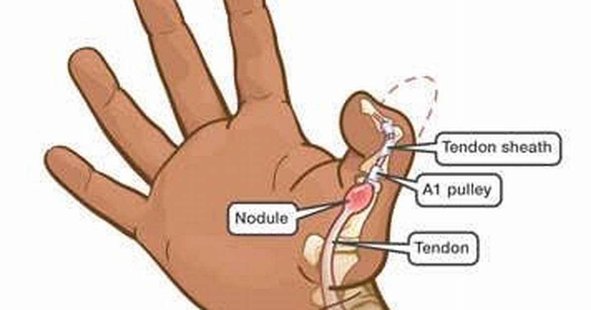 What Is a Tendon Nodule?