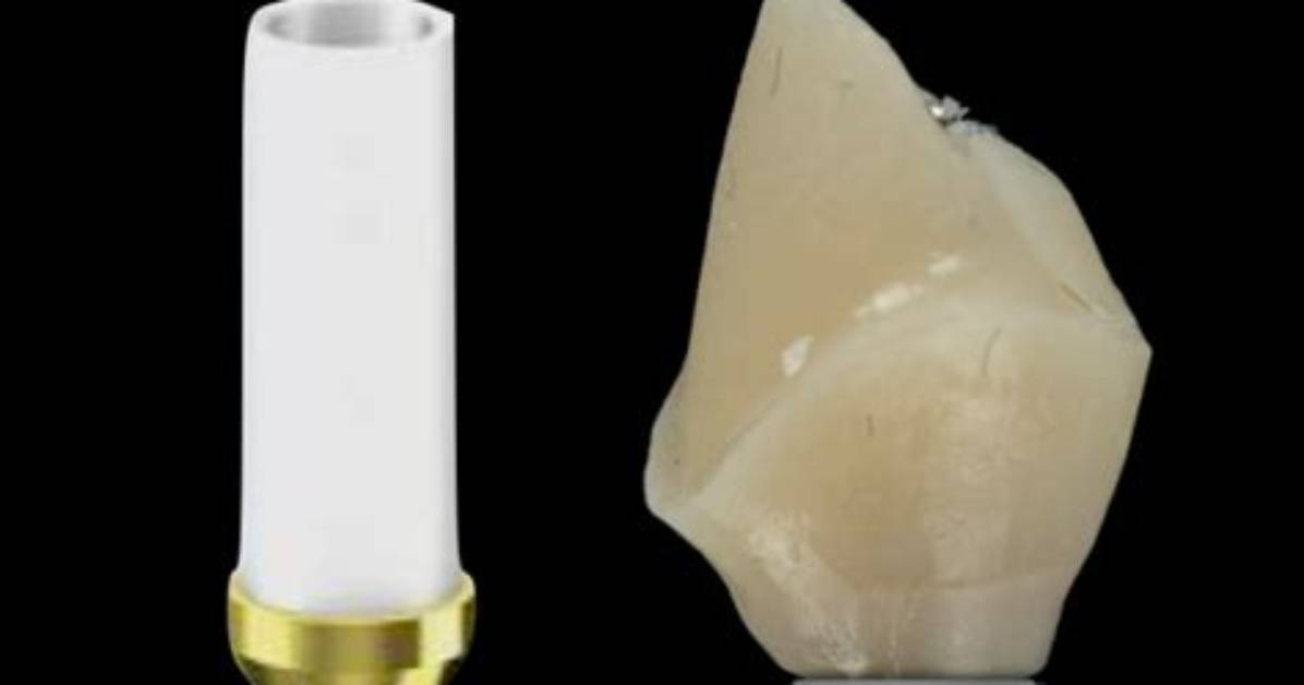 What Is a Ucla Abutment