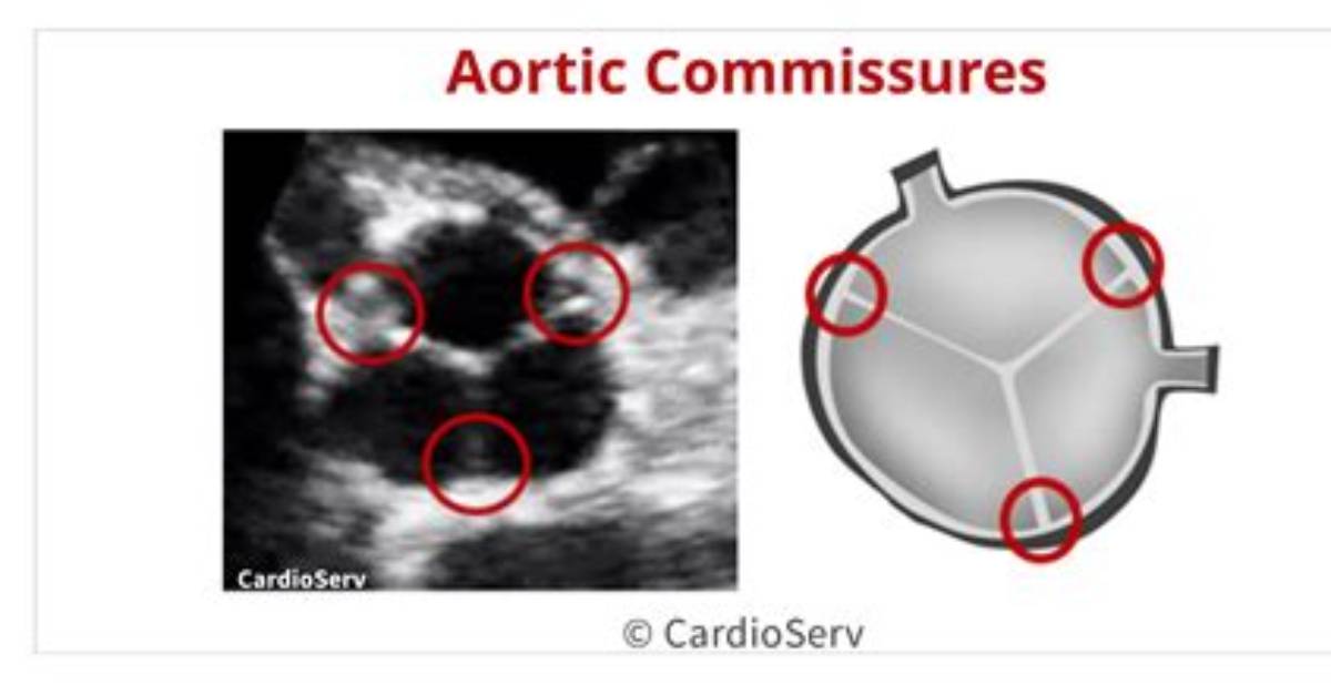 What Is a Valve Commissure