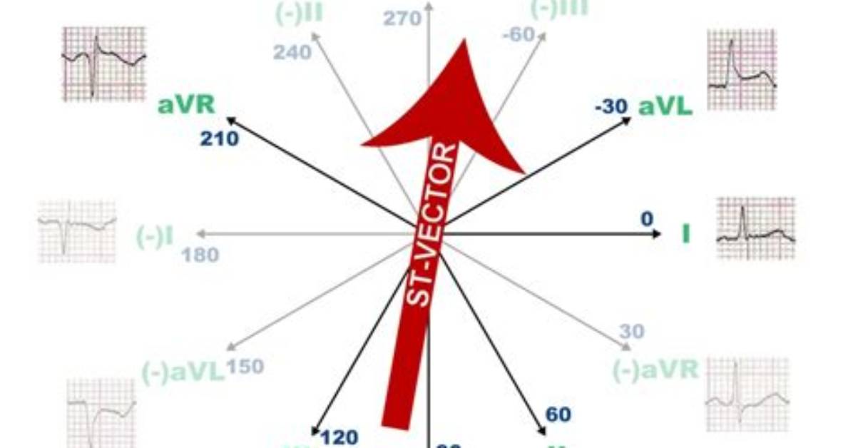 What Is a Vector Ecg