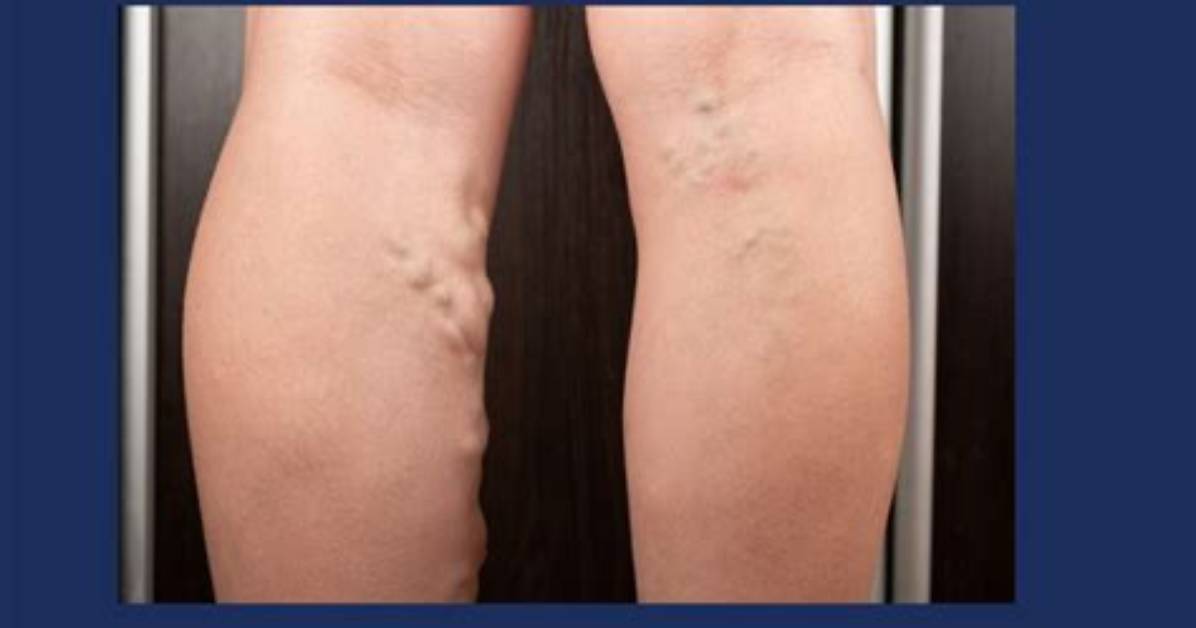 What Is a Vein Study