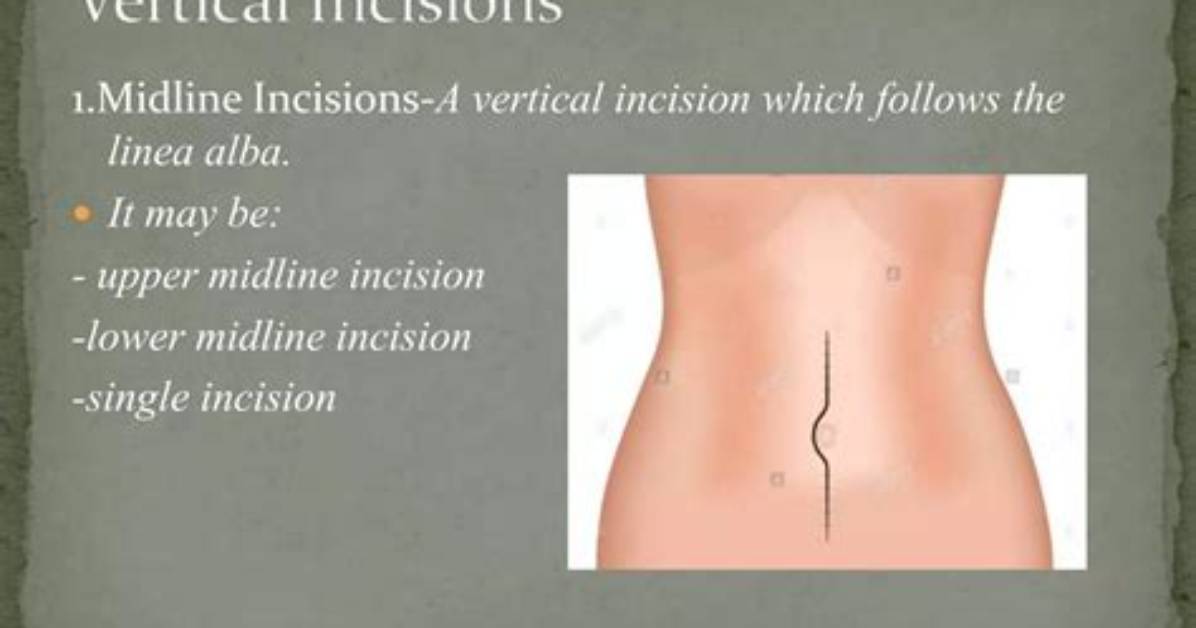 What Is a Vertical Incision