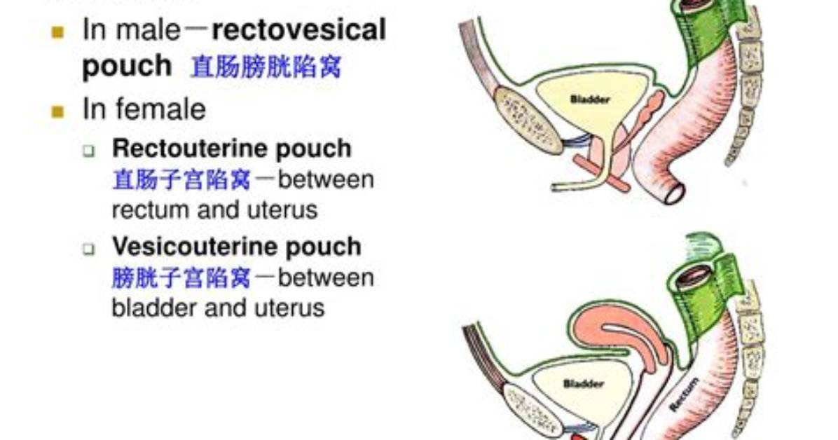 What Is a Vesicouterine Pouch?