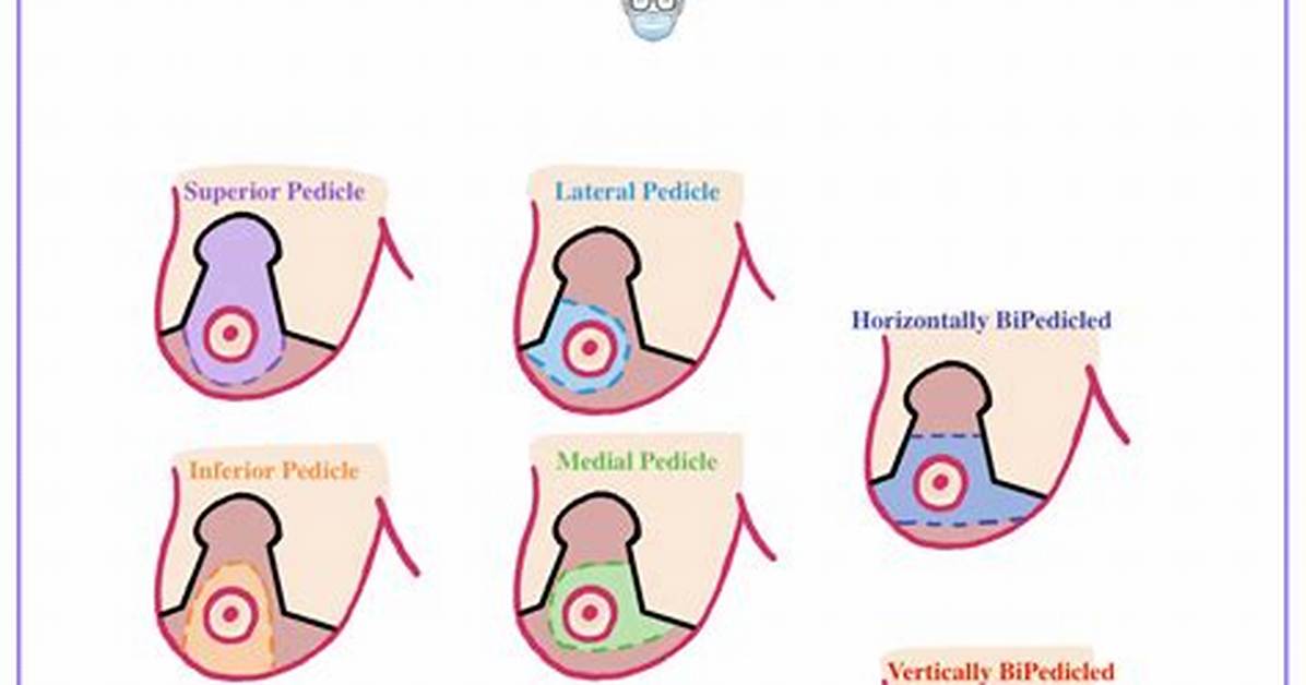 What Is a Wise Pattern Mastopexy
